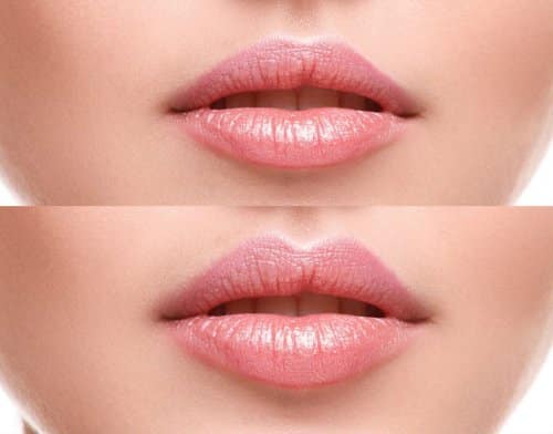 the woman`s lips before and after creating the Perfect Lip Shape Using Dermal Fillers