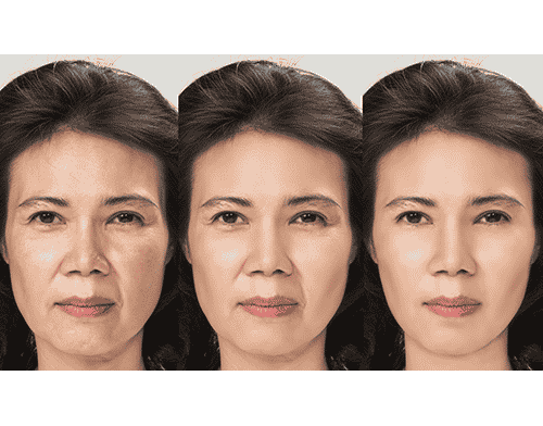 A chinese patient`s face before, between and after treating wit the best filler