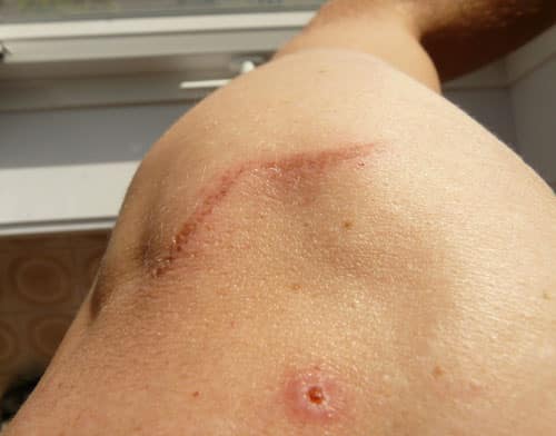 A back of a man before treating scars with dermal fillers