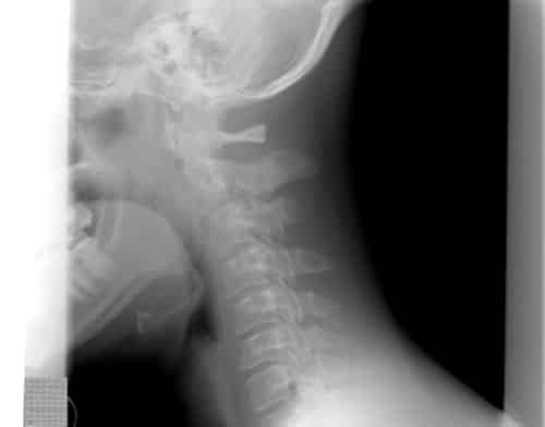 x-ray of the neck that needs treatment of Cervical Dystonia with Botox