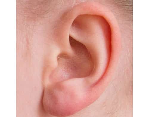 an ear after the Remodeling Procedure
