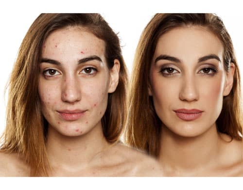 a woman`s face before and after treating Acne Scarring with Dermal Fillers
