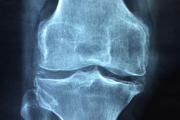 x-ray of a joint that needs viscosupplement Supartz or Synvisc