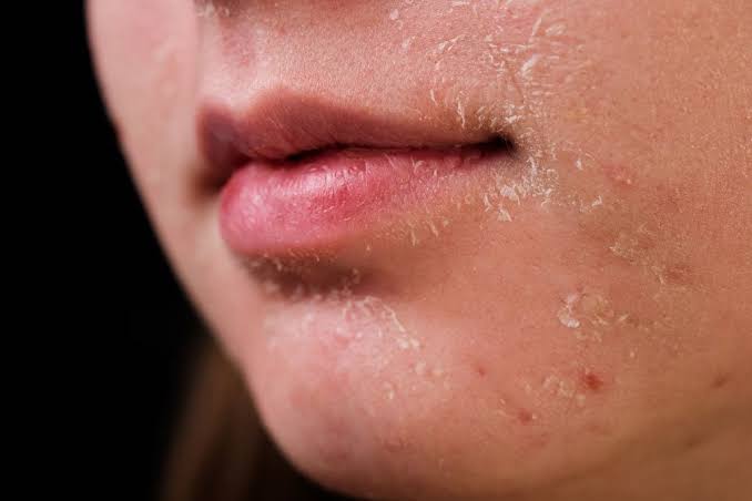 face with dry skin