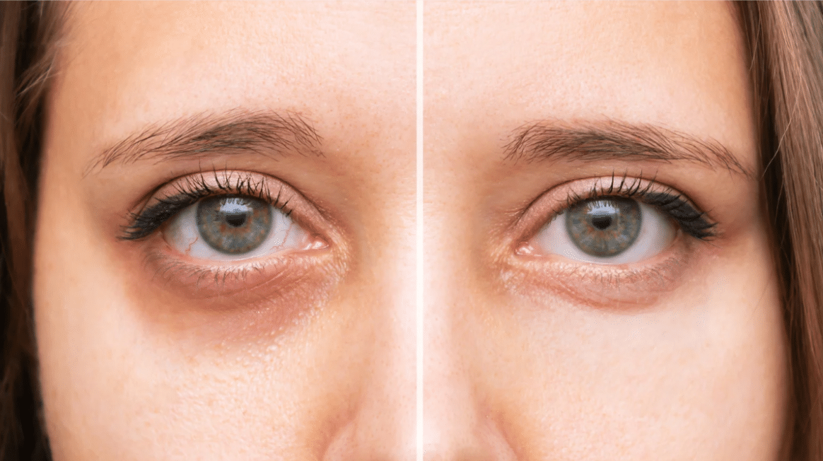 The Benefits of Using Filorga Eye Filler for Dark Circles and Under Eye Bags