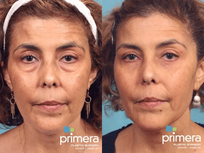 A female patient receives Dysport to resolve crow's feet after getting lower blepharoplasty.