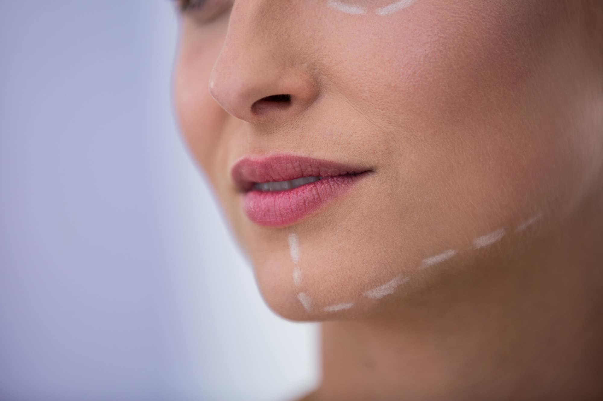 A female patient with markings across her jawline before cosmetic treatment.