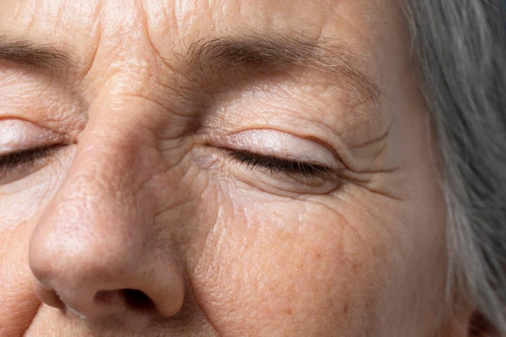A senior patient with drooping eyebrows, and wrinkles and creases around the eyes.
