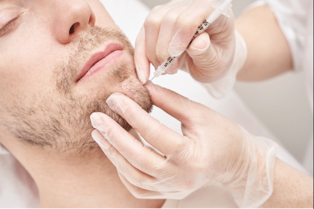 male getting ellanse filler