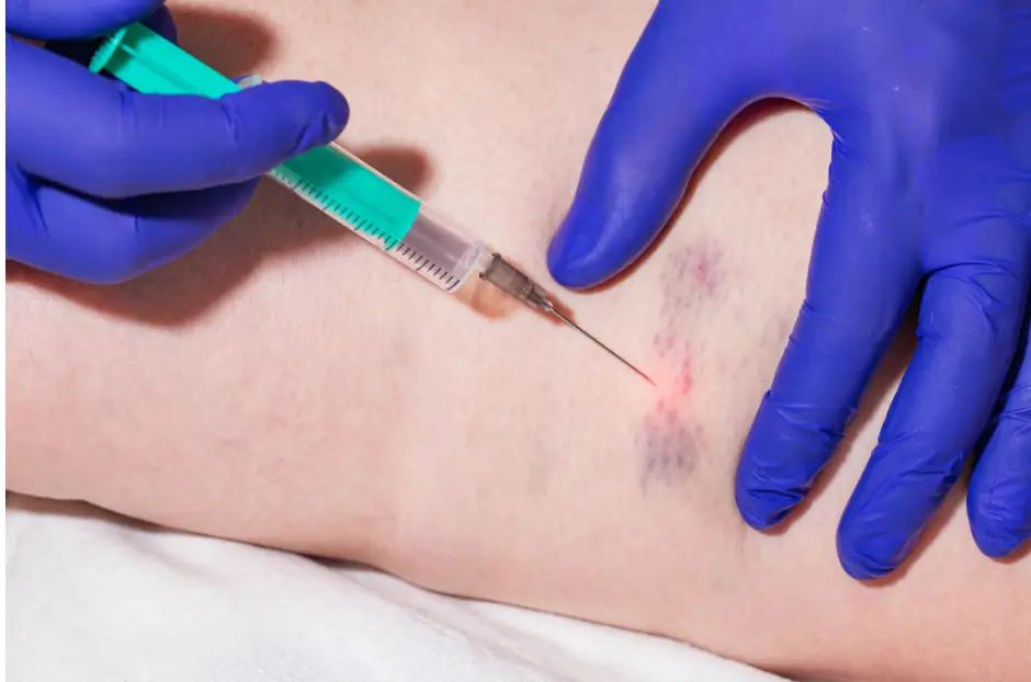 injection bruise
