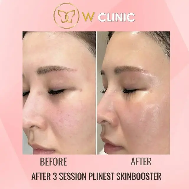 plinest real results