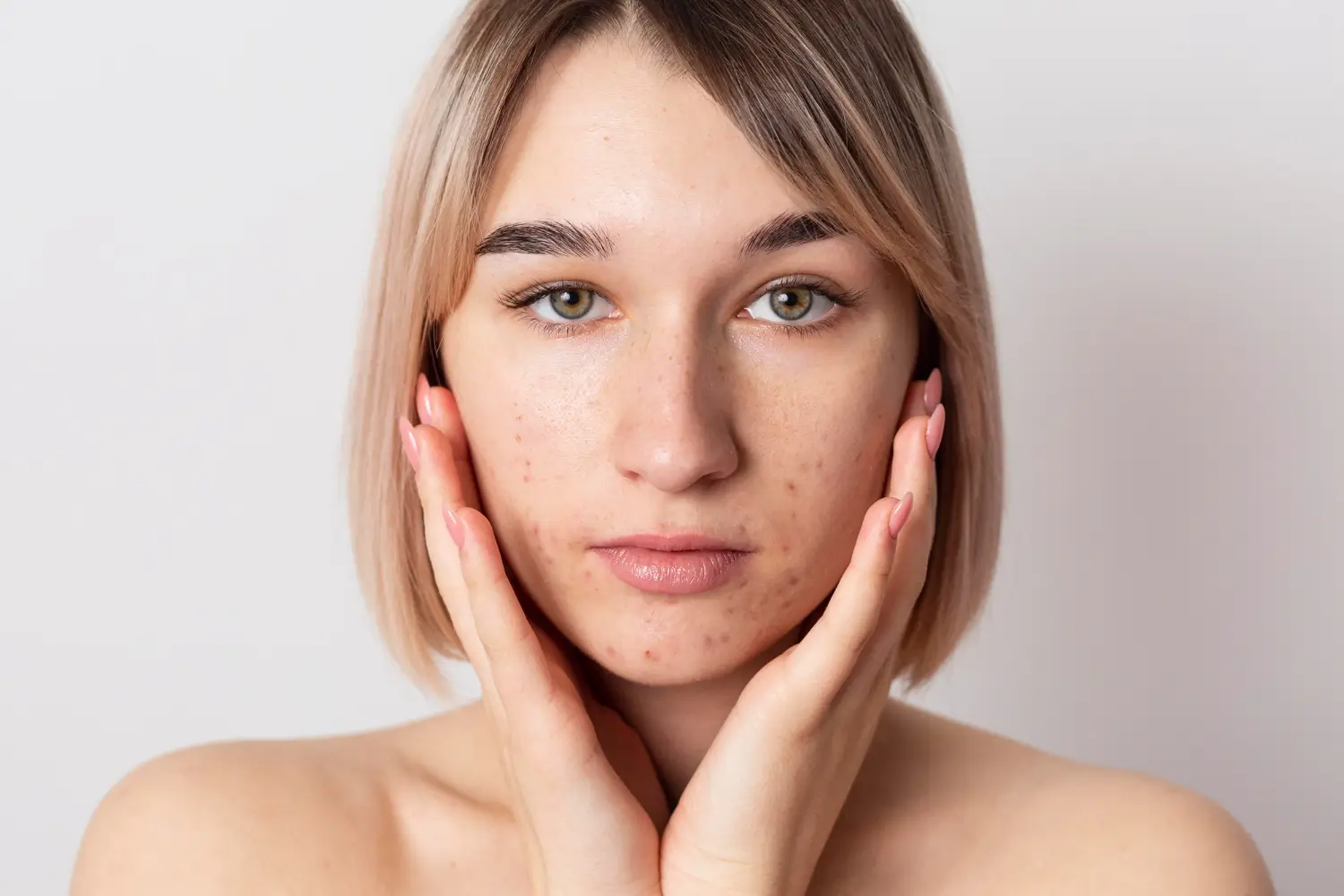 acne marks on cheeks
