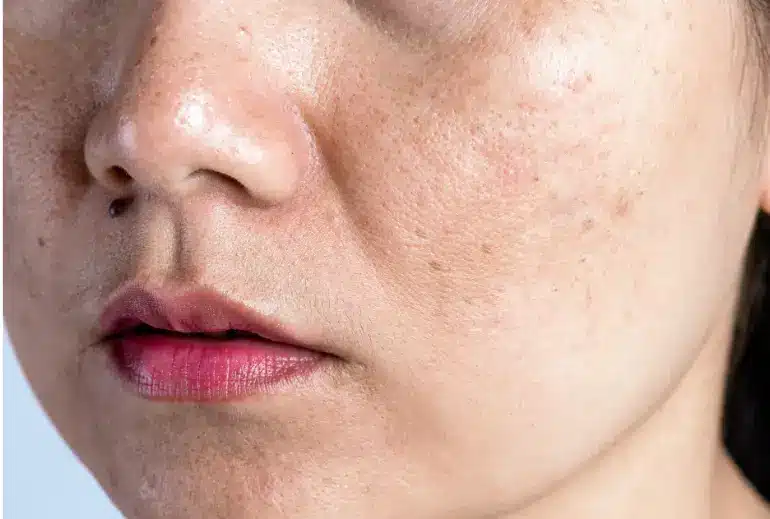 uneven tone