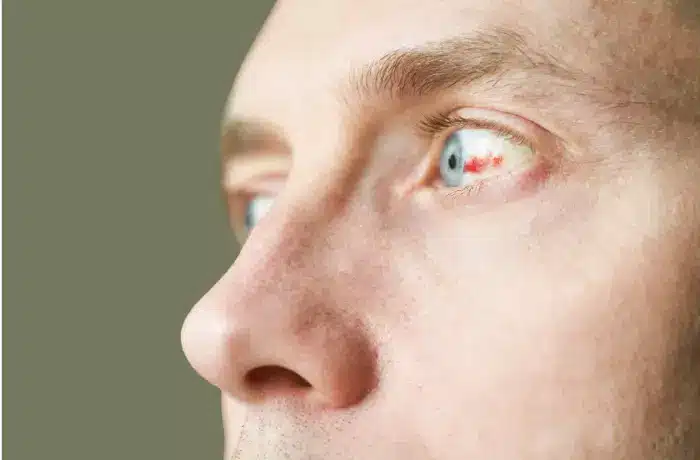 his eyes got blood in his left eye