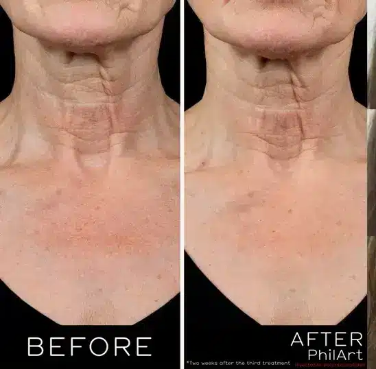 skin in the neck