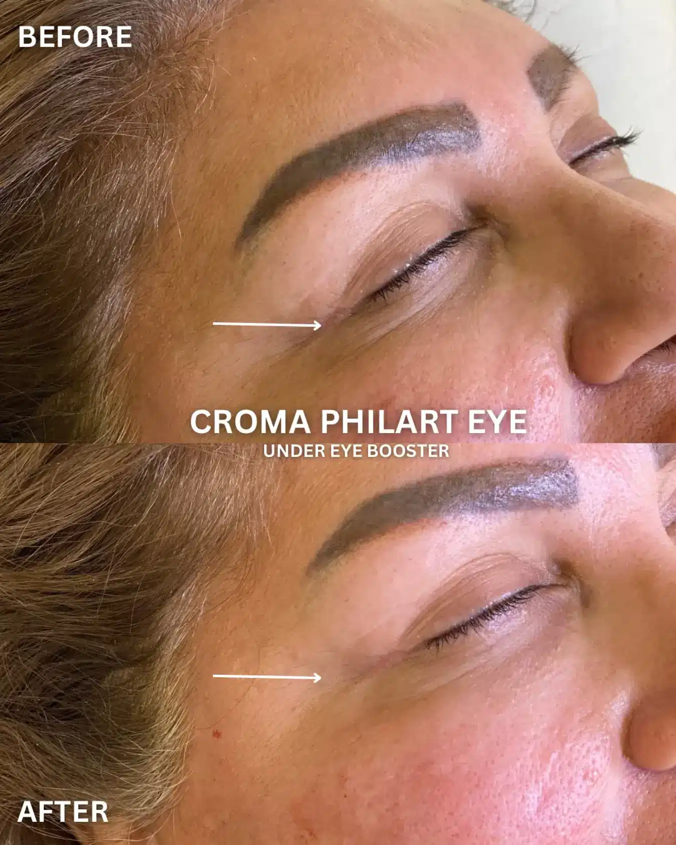 less face wrinkle