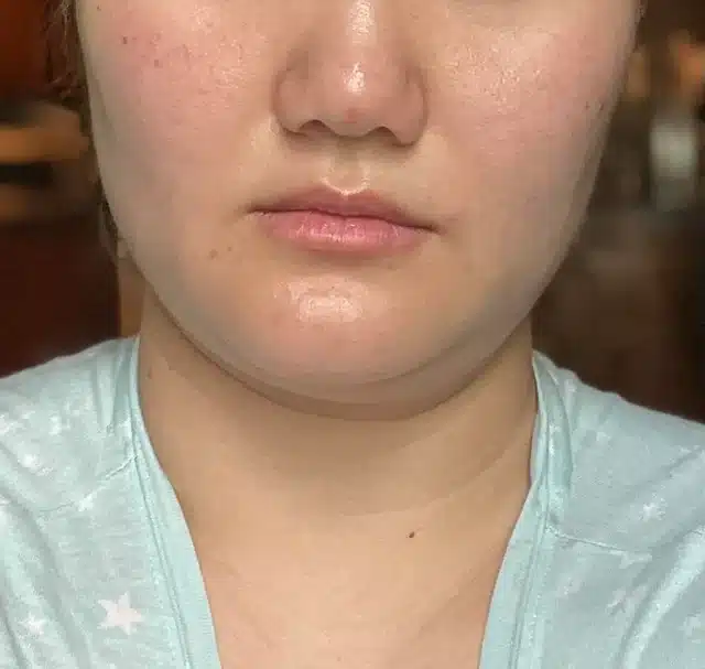 fatty chin