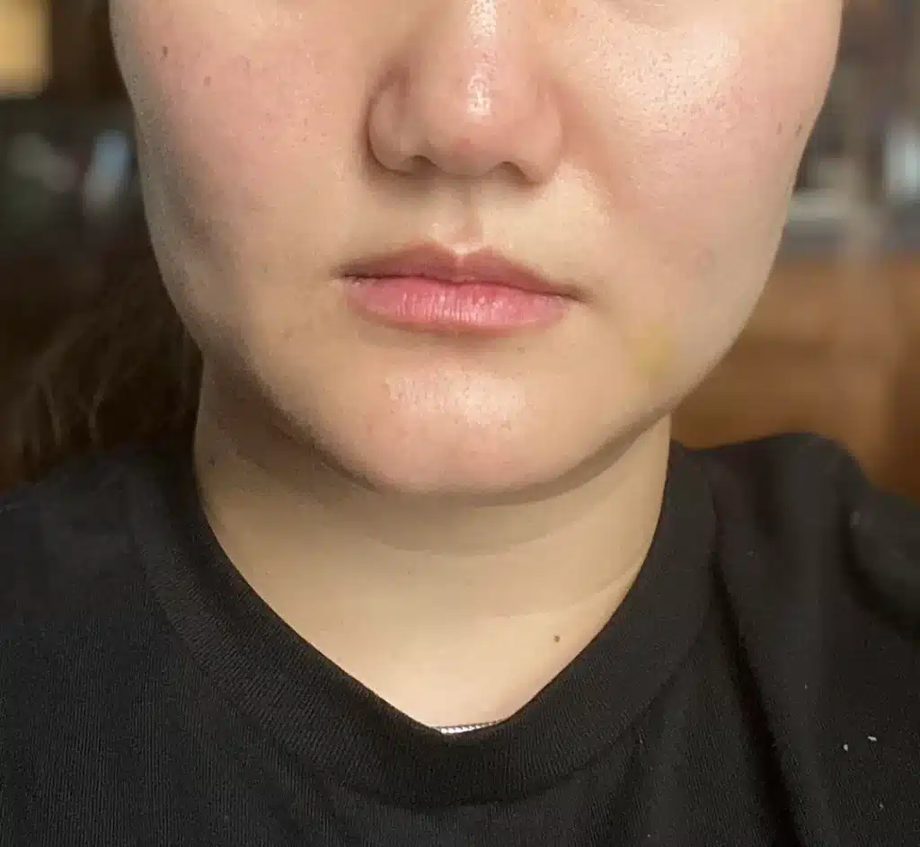 improved chin