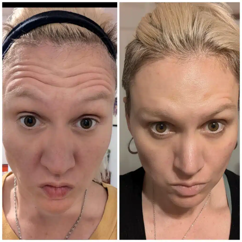 wrinkle-free forehead