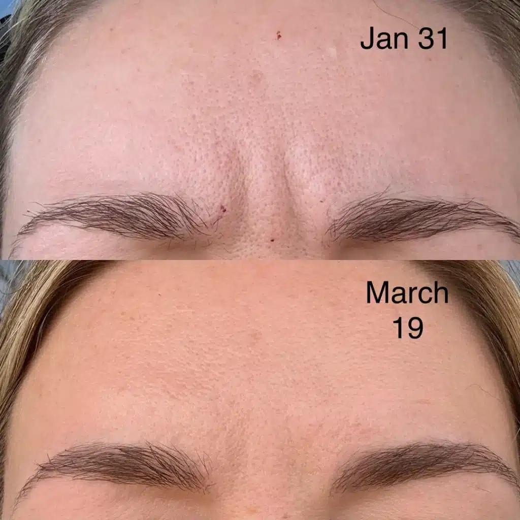 smoother forehead