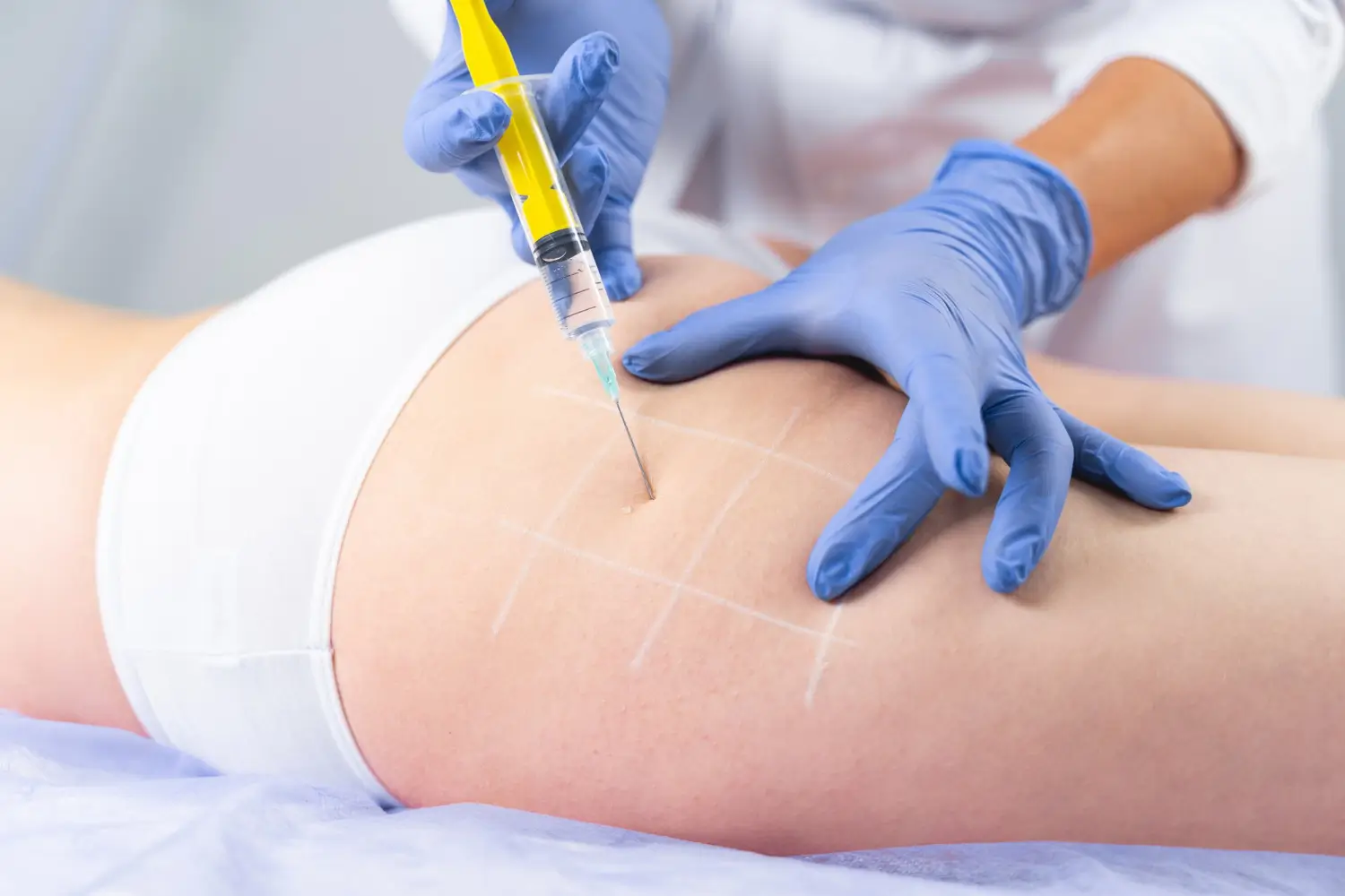 hip injection that will eliminate the fats