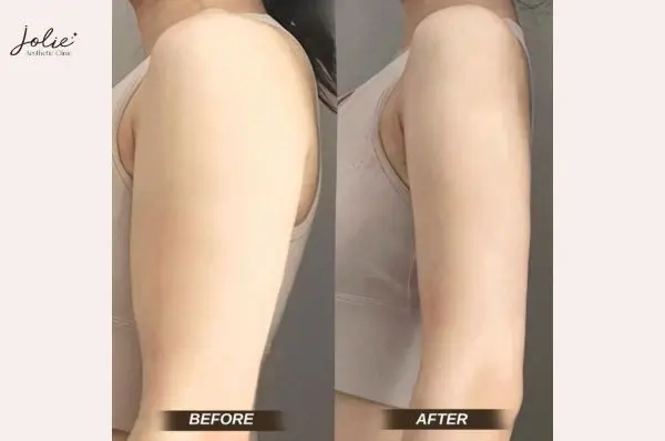 slim arms