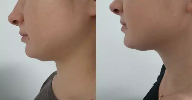firmer chin achieved
