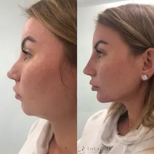 less fat in the chin