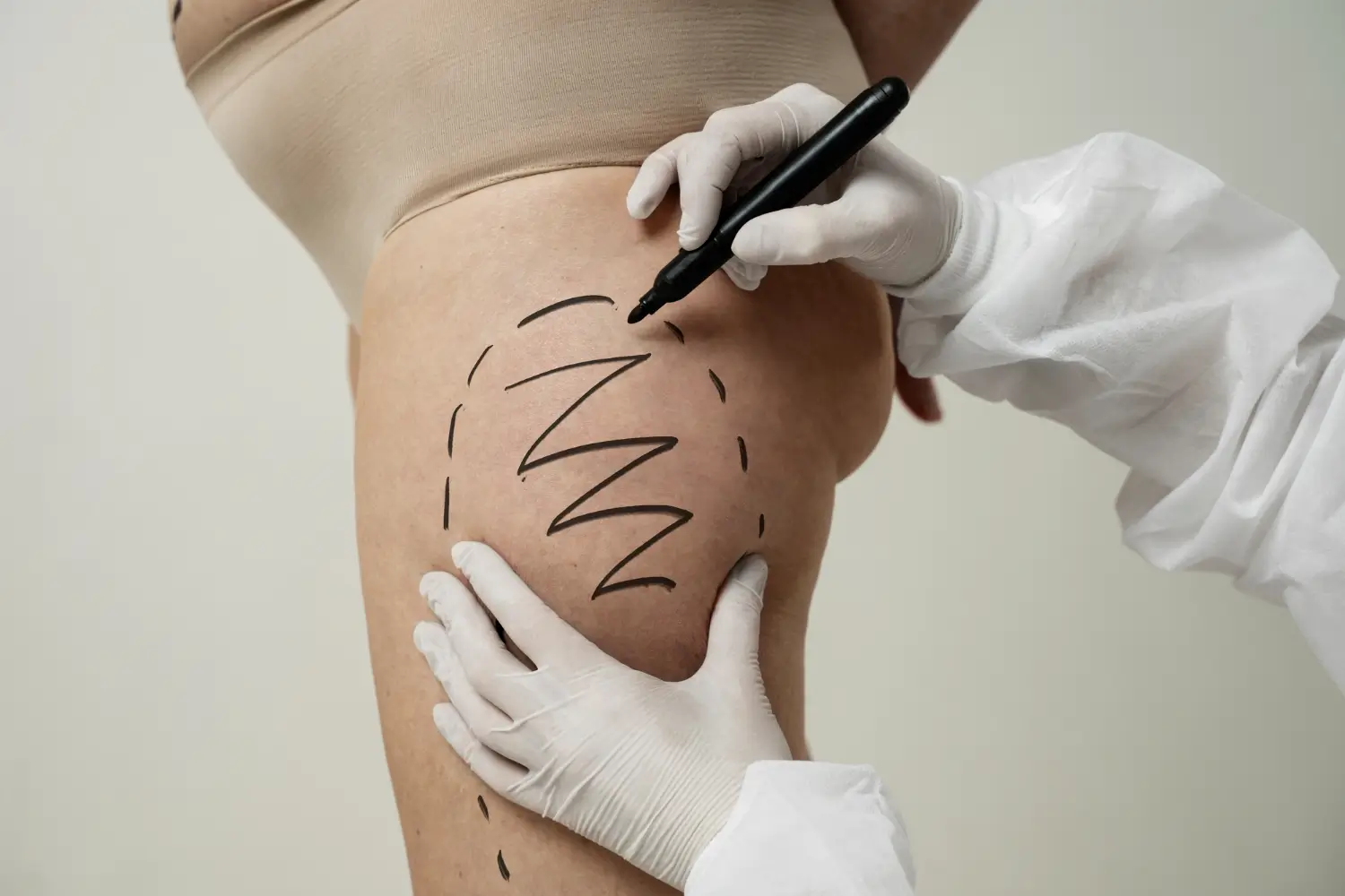 Aqualyx vs Lemon Bottle – Comparing Fat Dissolving Treatments
