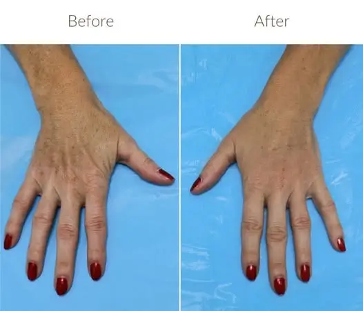her hand then and now
