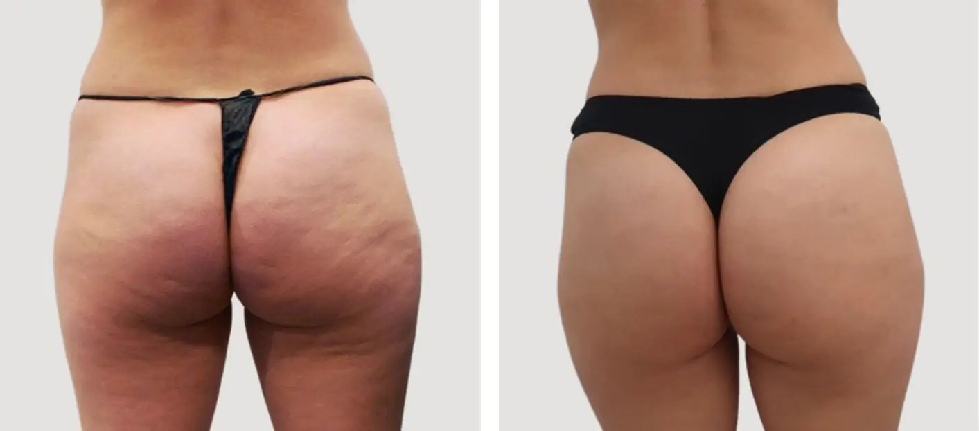 smoother and firmer thighs