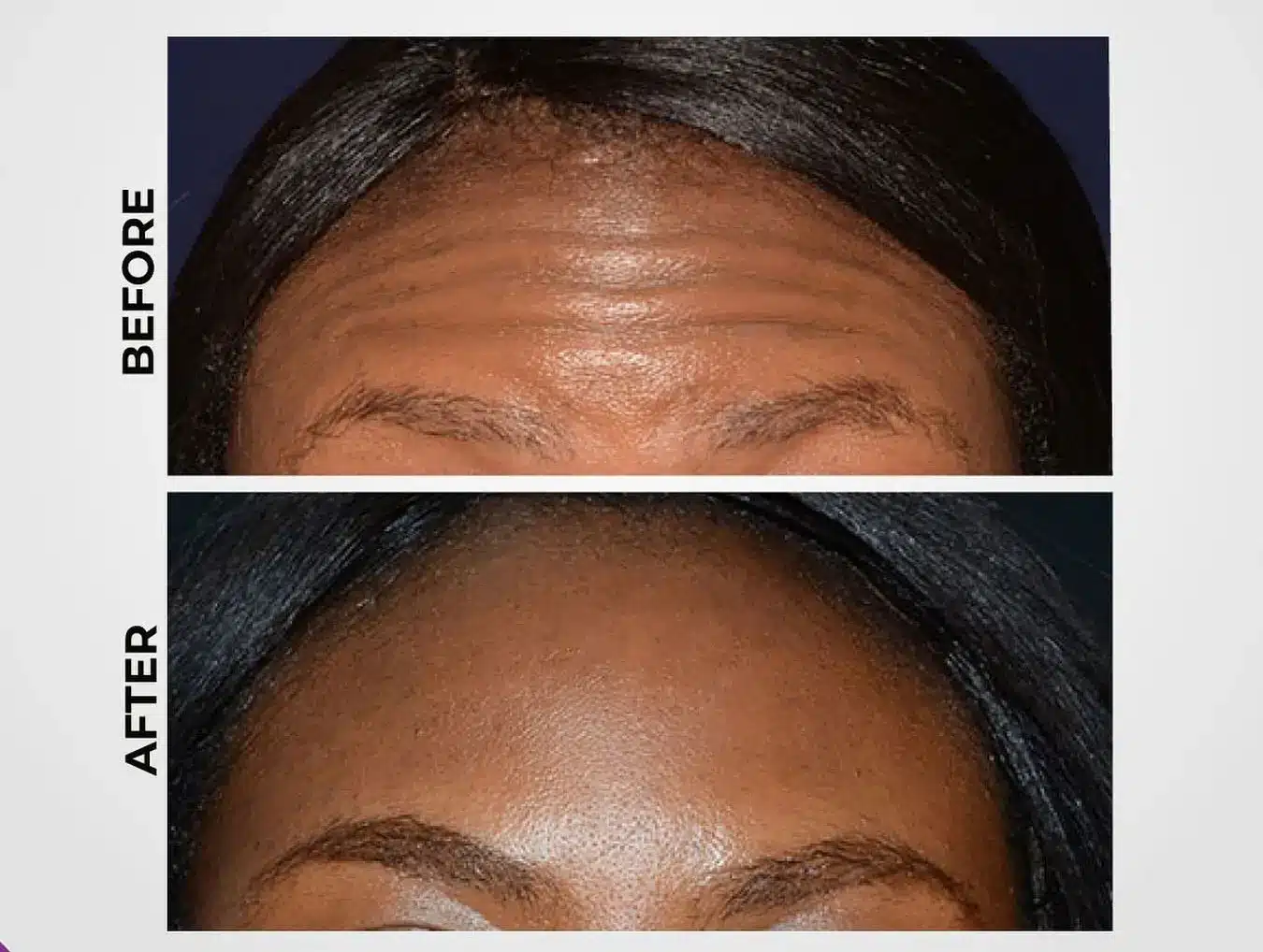 smoother forehead