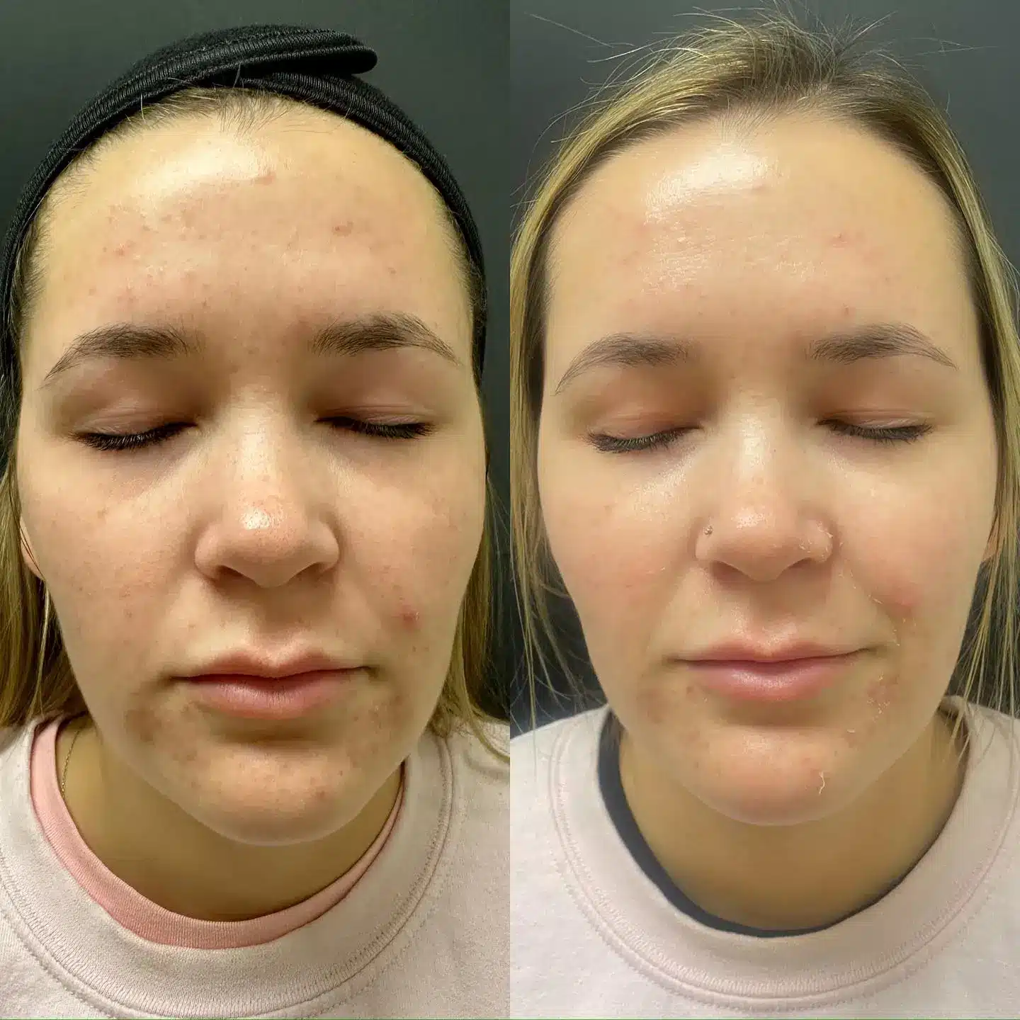 A woman patient shows her renewed skin using a peeling treatment.