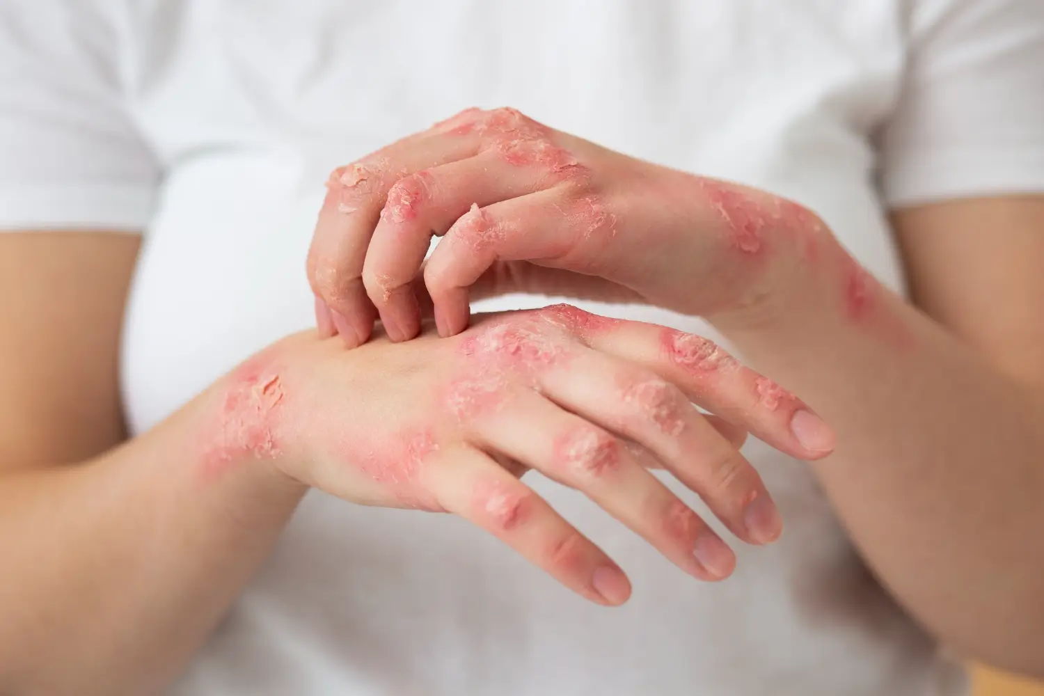 Woman sufffers from severe skin rash due to an autoimmune disease.