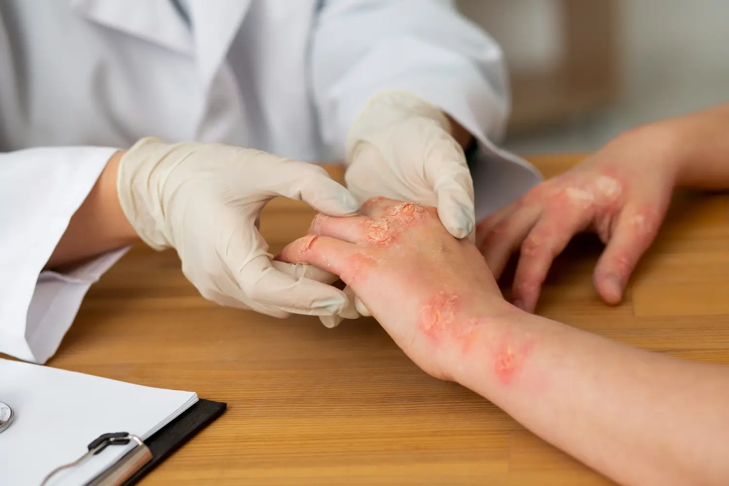 A doctor in a lab coat and gloves examines a patient's hands with a severe skin condition, like eczema or psoriasis.