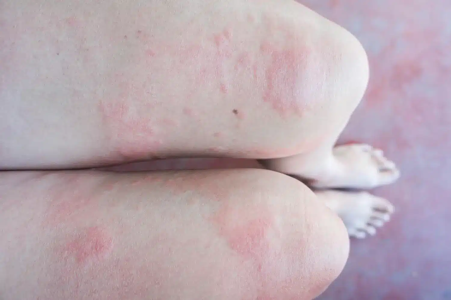 A person's legs with red, itchy hives from an allergic reaction or skin condition like urticaria.