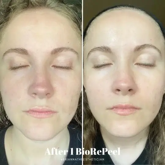 Studio B Beauty Lounge BioRePeel (1)