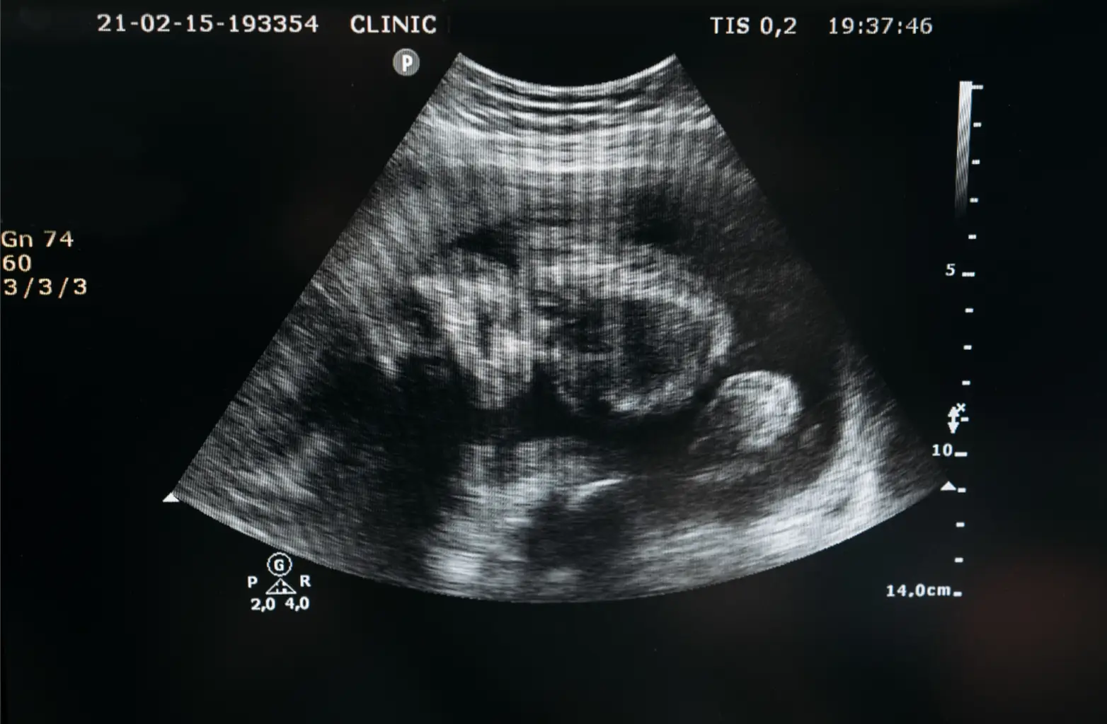 ultrasound of the baby