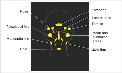 injection spots