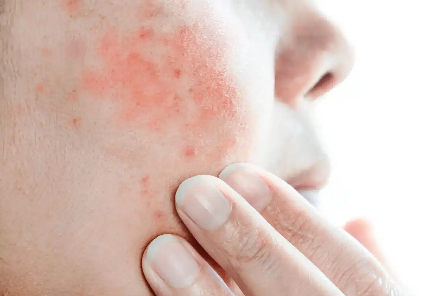 Close-up of inflamed, sensitive skin with redness and irritation.