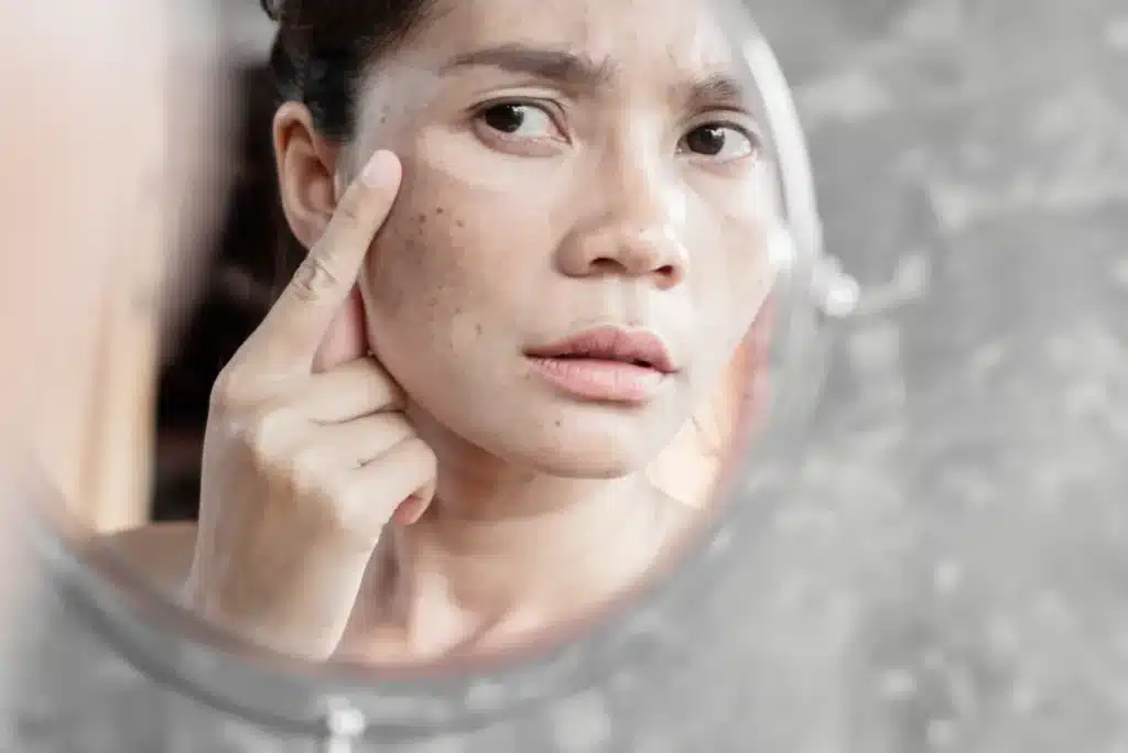 Woman examines hyperpigmentation as a side effect oof facial peeling solution, maybe BioRePeel or other treatment.