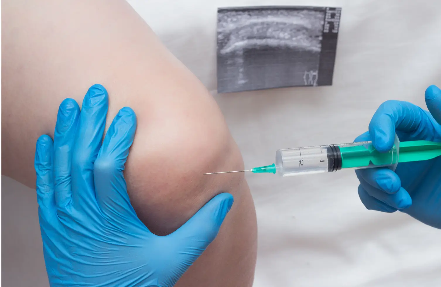 Knee injection guided by ultrasound for precise joint pain relief.